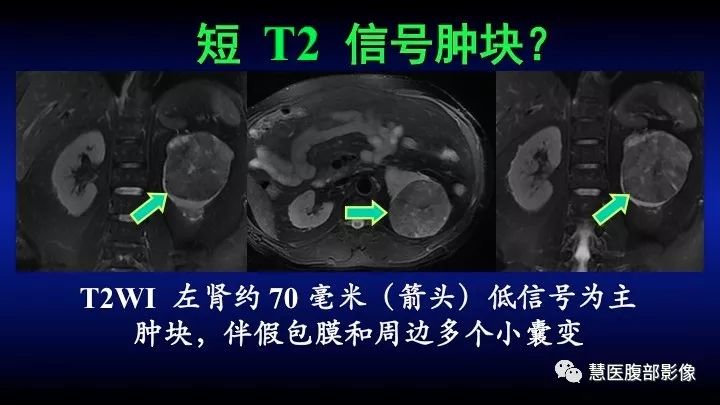 影像PPT - 【PPT】肾脏短T2局灶病变MRI表现与鉴别诊断思路-16