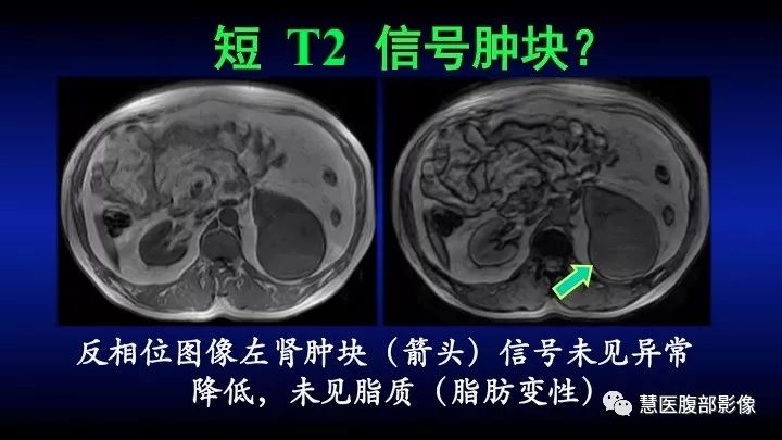 影像PPT - 【PPT】肾脏短T2局灶病变MRI表现与鉴别诊断思路-17