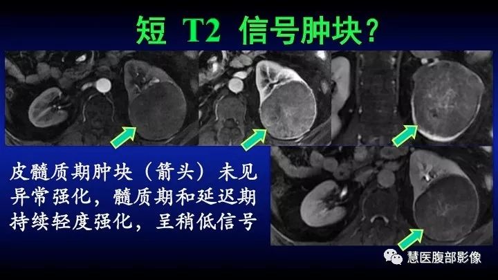 影像PPT - 【PPT】肾脏短T2局灶病变MRI表现与鉴别诊断思路-18