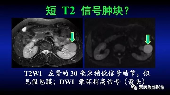 影像PPT - 【PPT】肾脏短T2局灶病变MRI表现与鉴别诊断思路-21