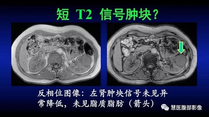 影像PPT - 【PPT】肾脏短T2局灶病变MRI表现与鉴别诊断思路-22