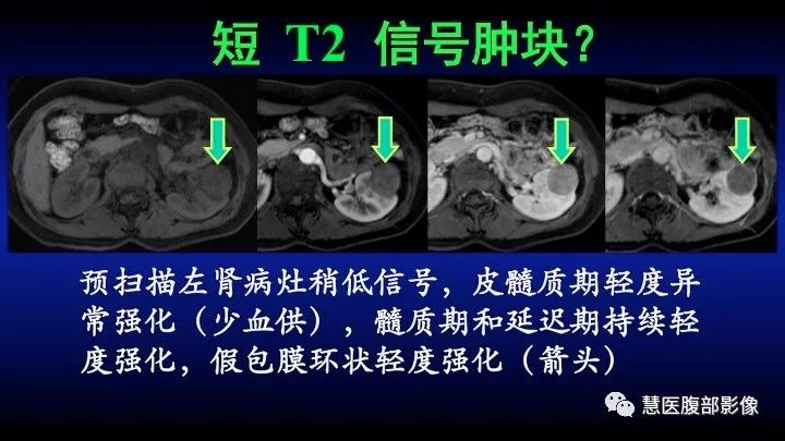 影像PPT - 【PPT】肾脏短T2局灶病变MRI表现与鉴别诊断思路-23