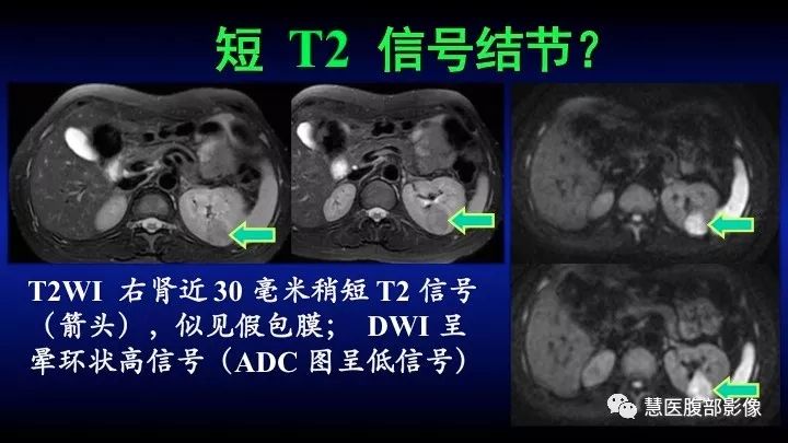 影像PPT - 【PPT】肾脏短T2局灶病变MRI表现与鉴别诊断思路-26