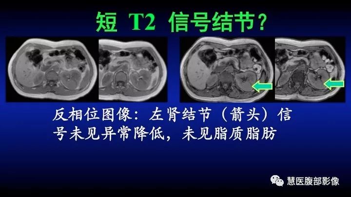 影像PPT - 【PPT】肾脏短T2局灶病变MRI表现与鉴别诊断思路-27