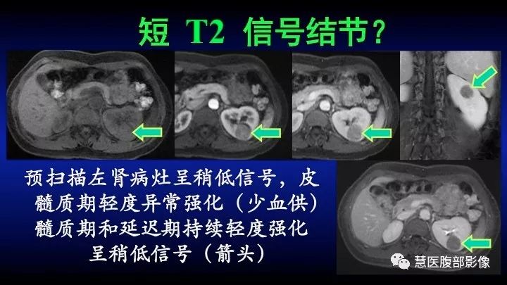 影像PPT - 【PPT】肾脏短T2局灶病变MRI表现与鉴别诊断思路-28