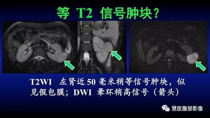 影像PPT - 【PPT】肾脏短T2局灶病变MRI表现与鉴别诊断思路-31
