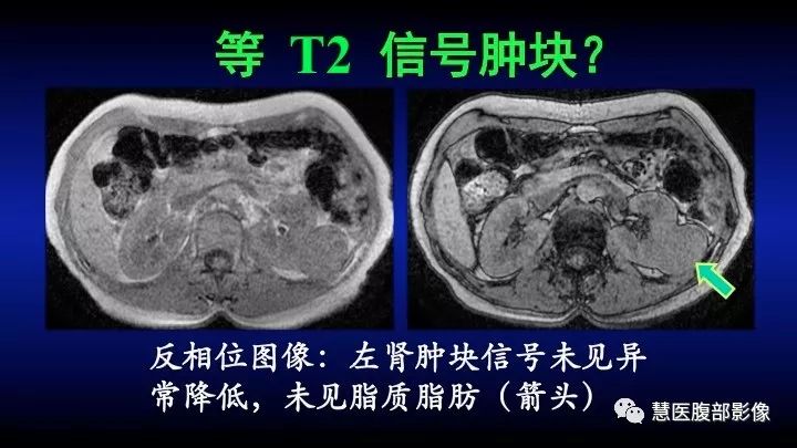 影像PPT - 【PPT】肾脏短T2局灶病变MRI表现与鉴别诊断思路-32