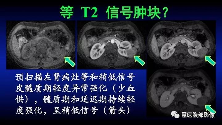 影像PPT - 【PPT】肾脏短T2局灶病变MRI表现与鉴别诊断思路-33