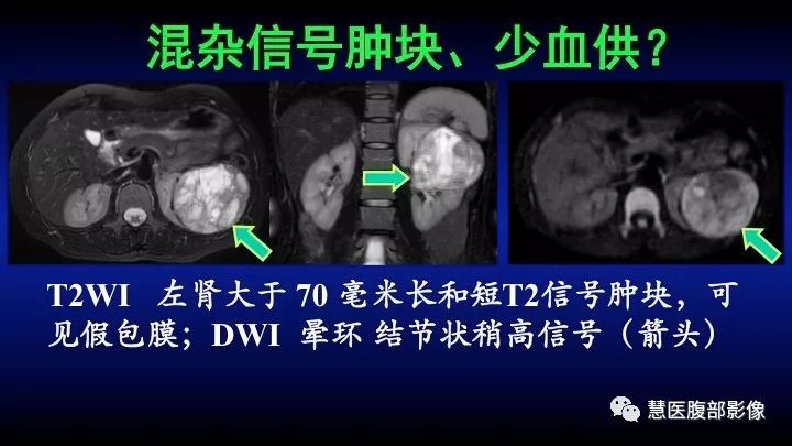影像PPT - 【PPT】肾脏短T2局灶病变MRI表现与鉴别诊断思路-36