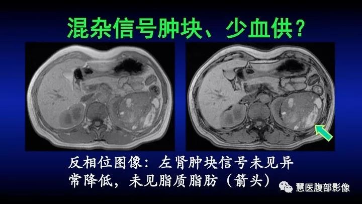 影像PPT - 【PPT】肾脏短T2局灶病变MRI表现与鉴别诊断思路-37