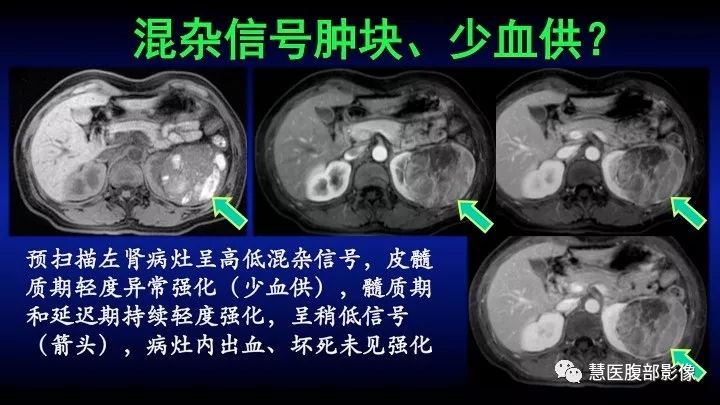 影像PPT - 【PPT】肾脏短T2局灶病变MRI表现与鉴别诊断思路-38