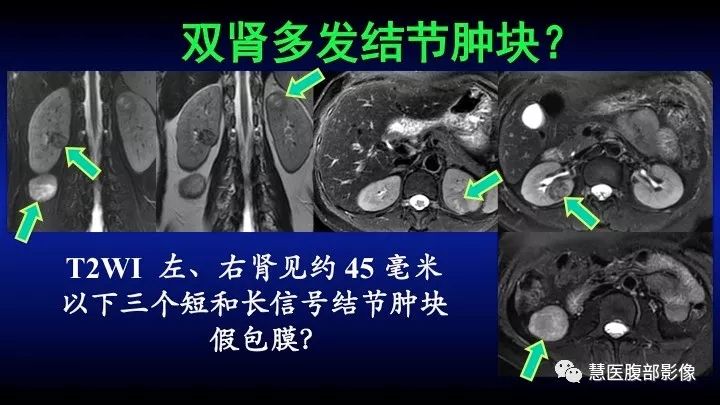 影像PPT - 【PPT】肾脏短T2局灶病变MRI表现与鉴别诊断思路-42