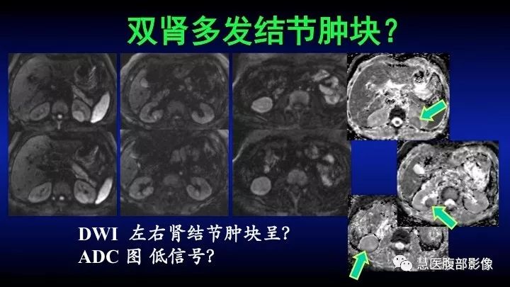 影像PPT - 【PPT】肾脏短T2局灶病变MRI表现与鉴别诊断思路-43
