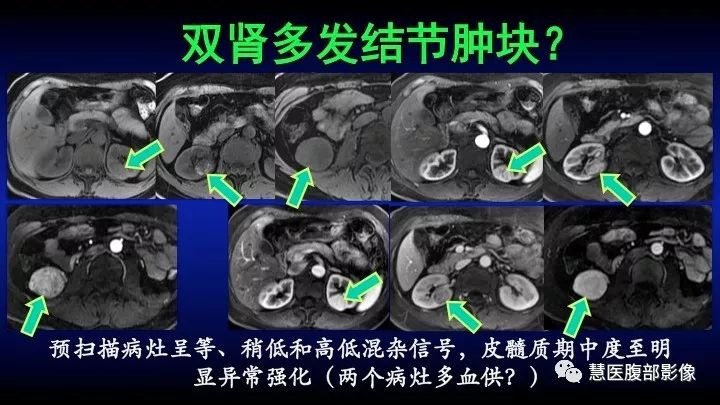 影像PPT - 【PPT】肾脏短T2局灶病变MRI表现与鉴别诊断思路-45