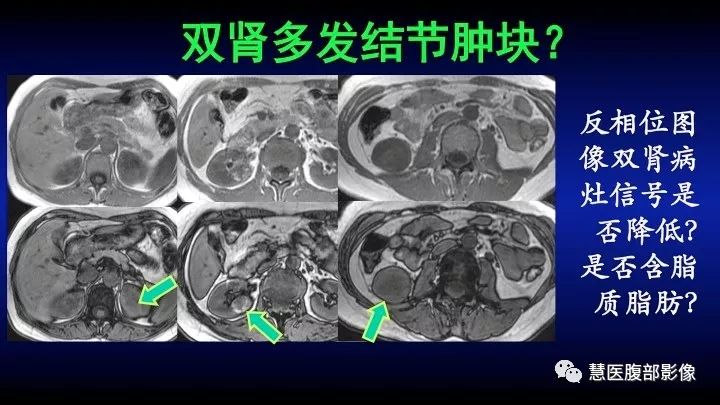 影像PPT - 【PPT】肾脏短T2局灶病变MRI表现与鉴别诊断思路-44