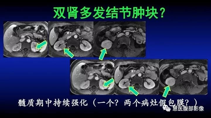 影像PPT - 【PPT】肾脏短T2局灶病变MRI表现与鉴别诊断思路-46
