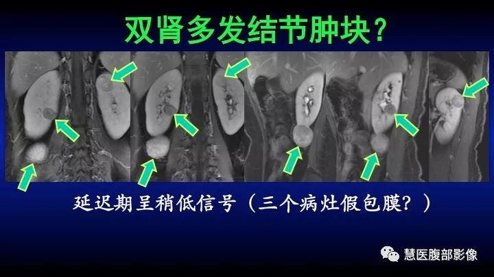 影像PPT - 【PPT】肾脏短T2局灶病变MRI表现与鉴别诊断思路-47