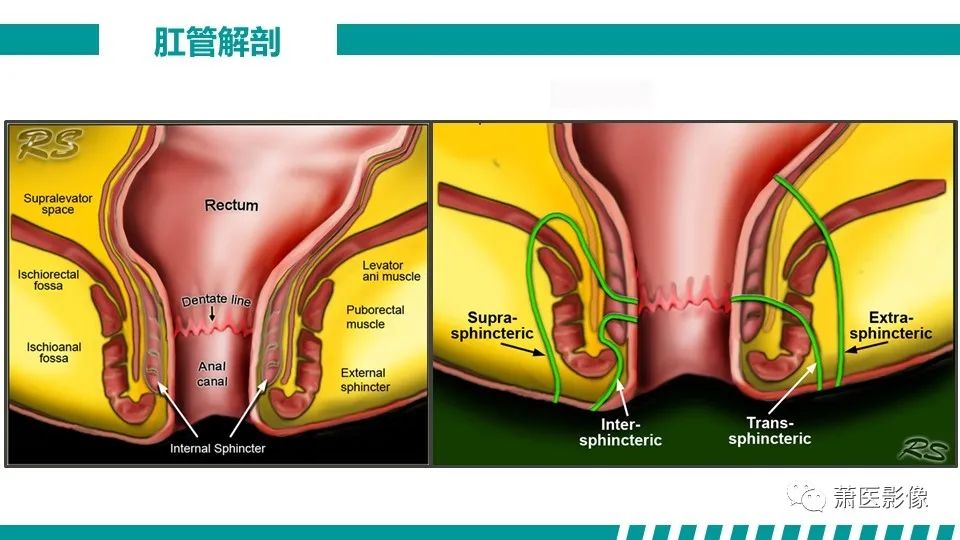 影像PPT - 【PPT】肛管及肛周区域病变MRI影像特征-10