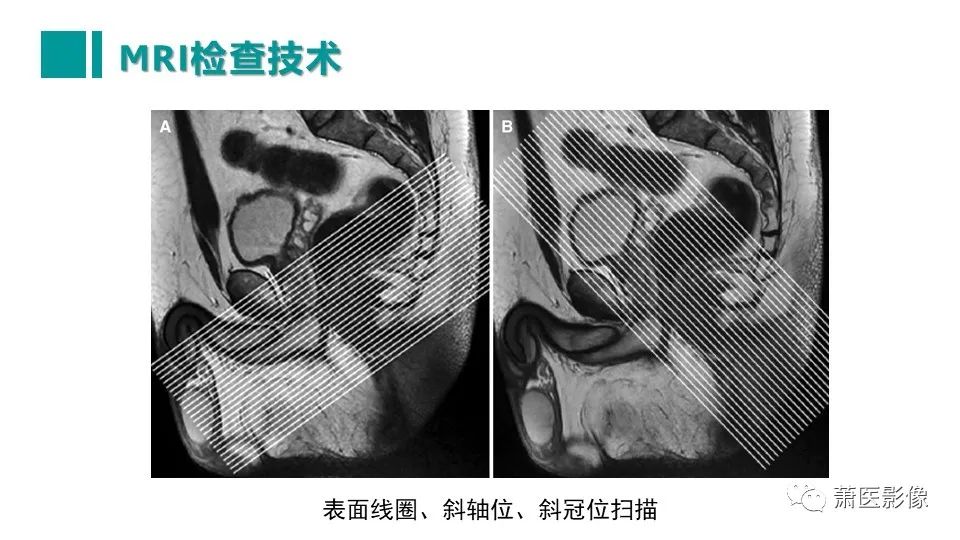 影像PPT - 【PPT】肛管及肛周区域病变MRI影像特征-15