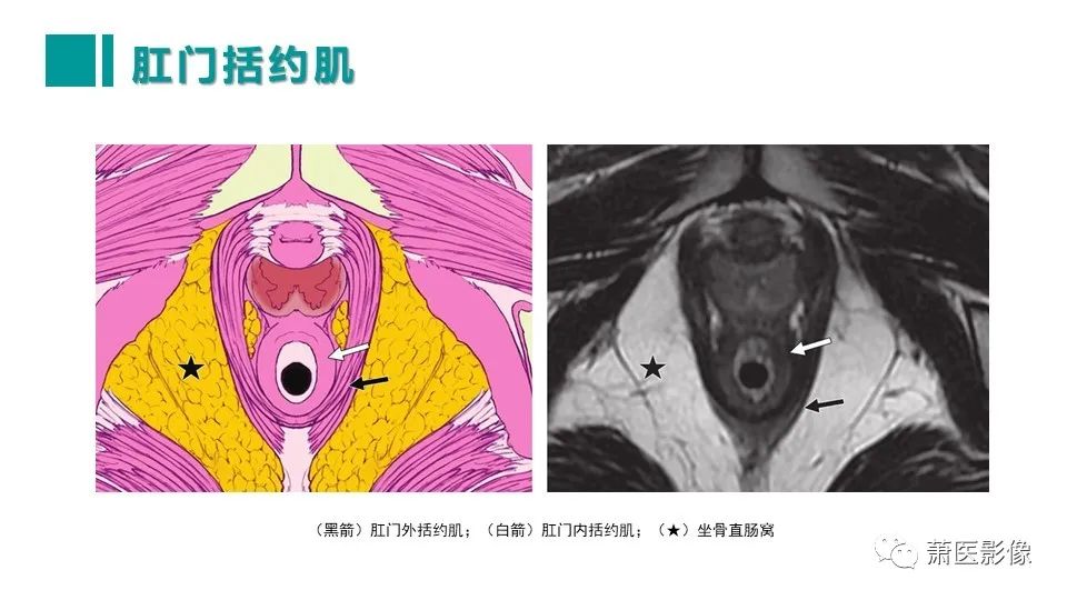 影像PPT - 【PPT】肛管及肛周区域病变MRI影像特征-16