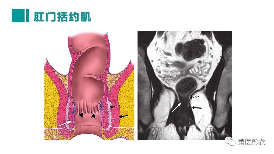 影像PPT - 【PPT】肛管及肛周区域病变MRI影像特征-17