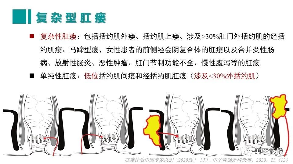 影像PPT - 【PPT】肛管及肛周区域病变MRI影像特征-20