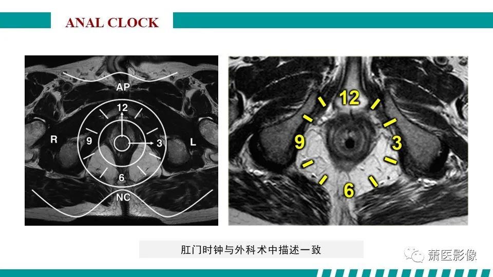 影像PPT - 【PPT】肛管及肛周区域病变MRI影像特征-22