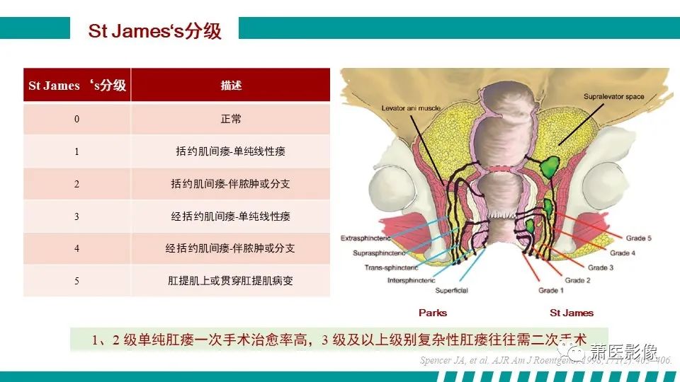 影像PPT - 【PPT】肛管及肛周区域病变MRI影像特征-24