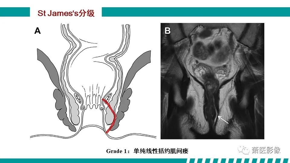 影像PPT - 【PPT】肛管及肛周区域病变MRI影像特征-25