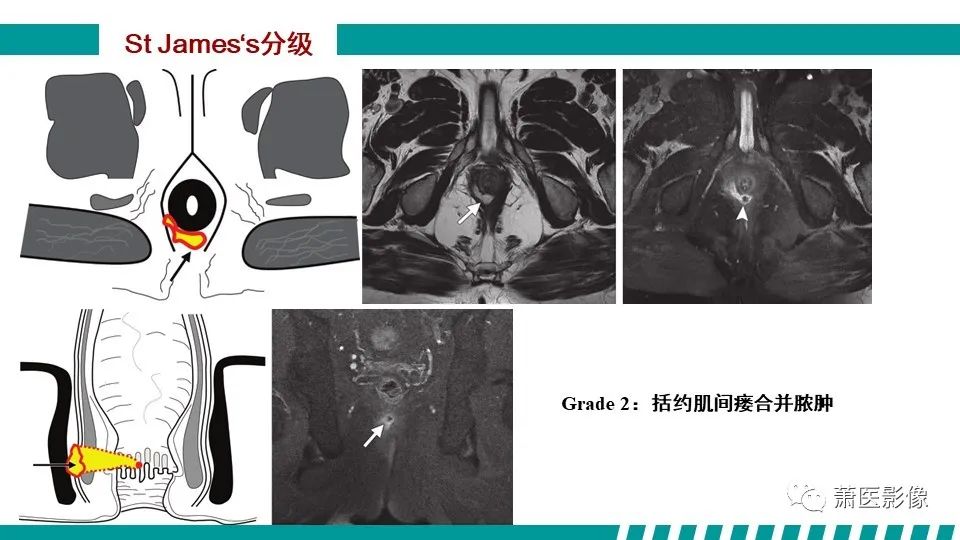 影像PPT - 【PPT】肛管及肛周区域病变MRI影像特征-26