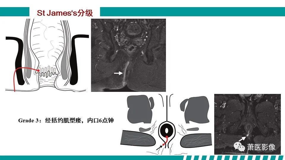 影像PPT - 【PPT】肛管及肛周区域病变MRI影像特征-27