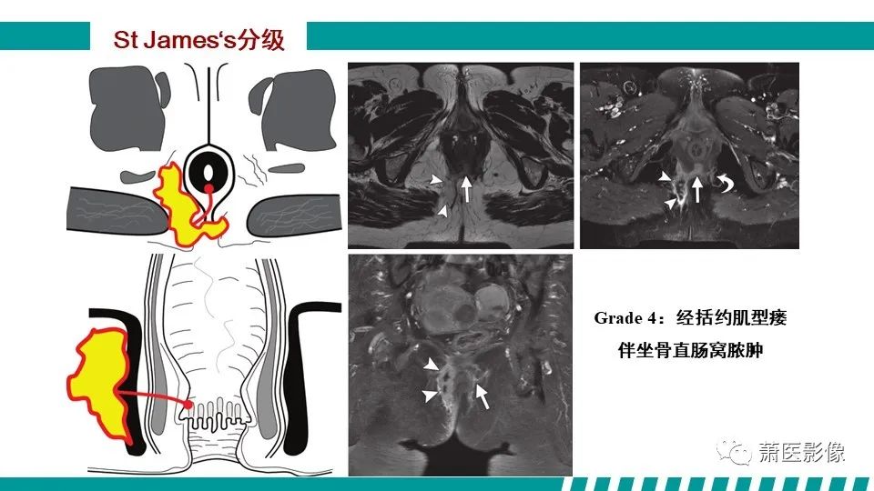 影像PPT - 【PPT】肛管及肛周区域病变MRI影像特征-28