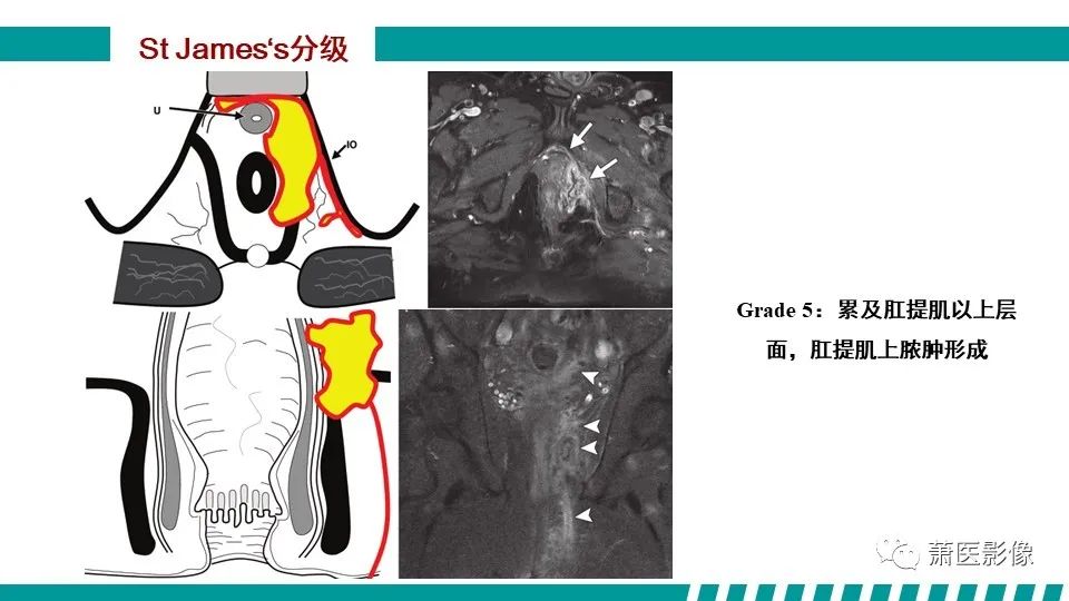 影像PPT - 【PPT】肛管及肛周区域病变MRI影像特征-29