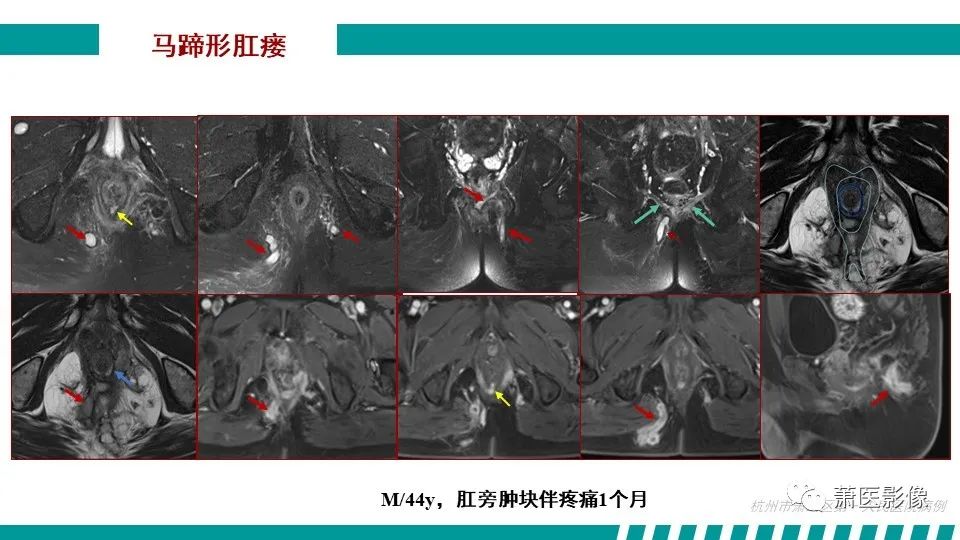 影像PPT - 【PPT】肛管及肛周区域病变MRI影像特征-31