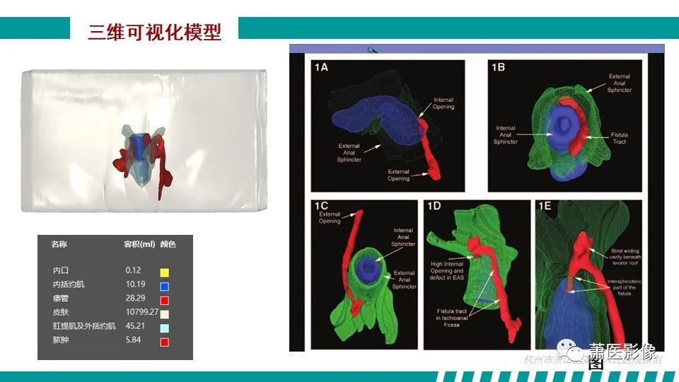 影像PPT - 【PPT】肛管及肛周区域病变MRI影像特征-32