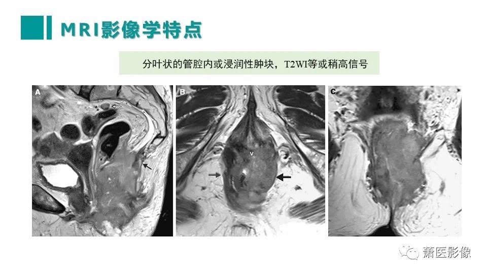 影像PPT - 【PPT】肛管及肛周区域病变MRI影像特征-35