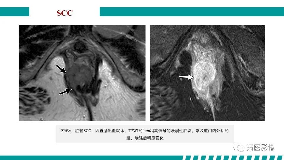 影像PPT - 【PPT】肛管及肛周区域病变MRI影像特征-36