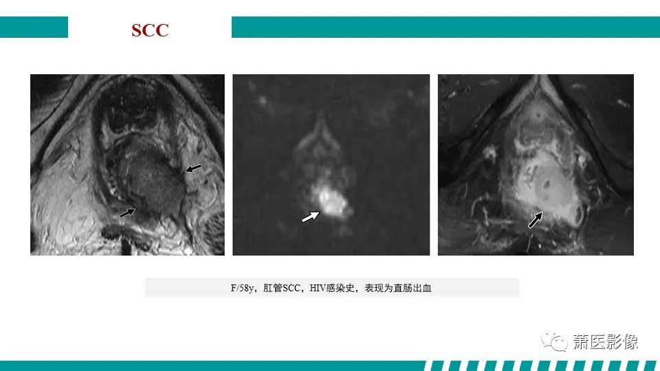 影像PPT - 【PPT】肛管及肛周区域病变MRI影像特征-37
