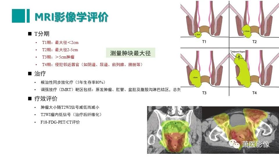 影像PPT - 【PPT】肛管及肛周区域病变MRI影像特征-39