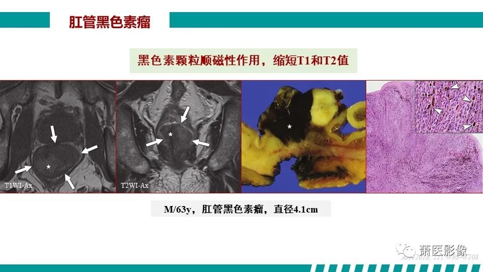 影像PPT - 【PPT】肛管及肛周区域病变MRI影像特征-44