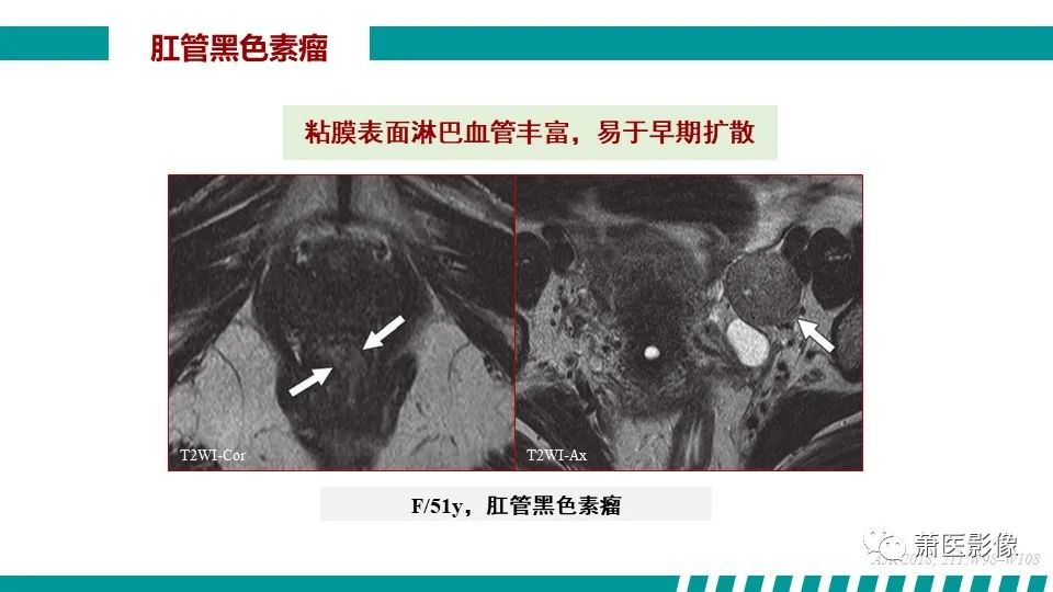 影像PPT - 【PPT】肛管及肛周区域病变MRI影像特征-45