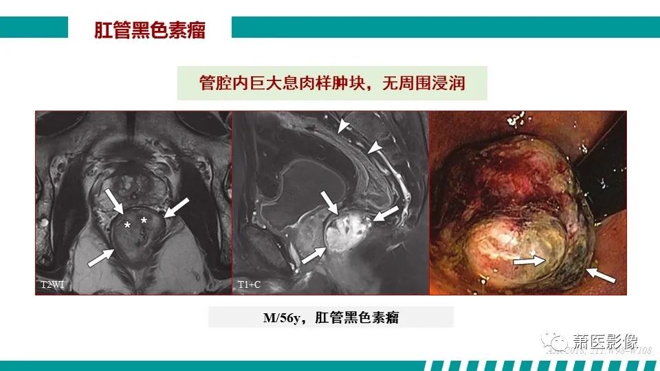 影像PPT - 【PPT】肛管及肛周区域病变MRI影像特征-46