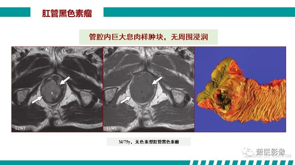 影像PPT - 【PPT】肛管及肛周区域病变MRI影像特征-47