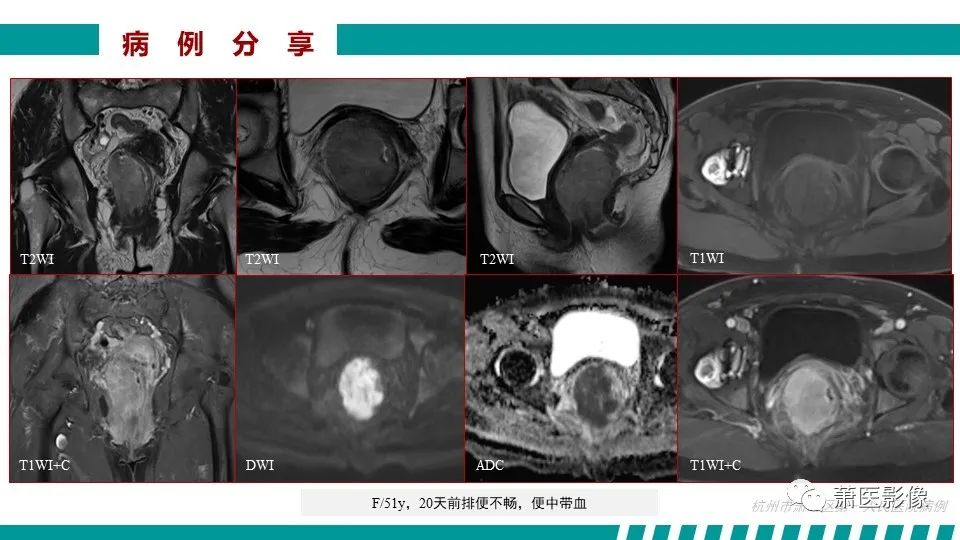 影像PPT - 【PPT】肛管及肛周区域病变MRI影像特征-48