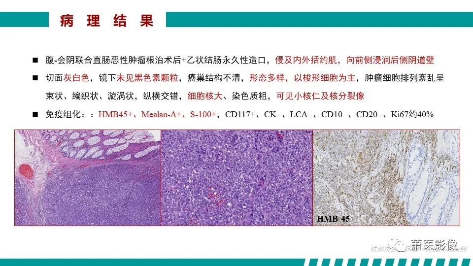 影像PPT - 【PPT】肛管及肛周区域病变MRI影像特征-49