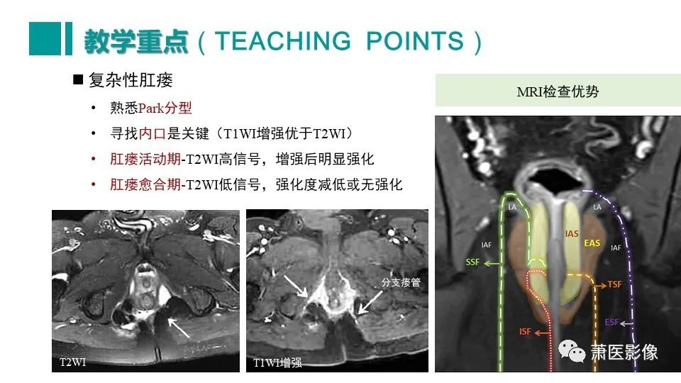 影像PPT - 【PPT】肛管及肛周区域病变MRI影像特征-53
