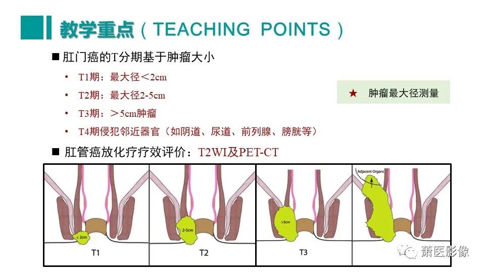 影像PPT - 【PPT】肛管及肛周区域病变MRI影像特征-54