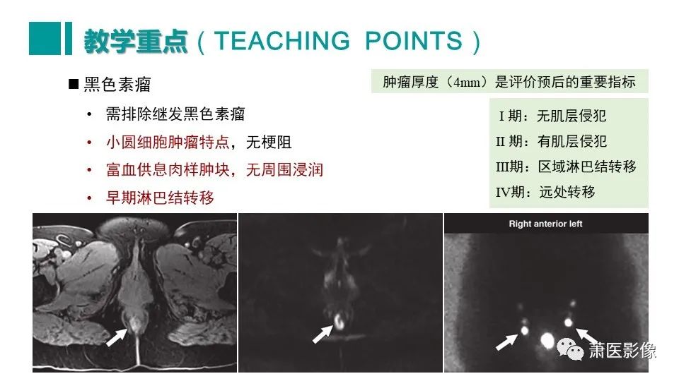 影像PPT - 【PPT】肛管及肛周区域病变MRI影像特征-55