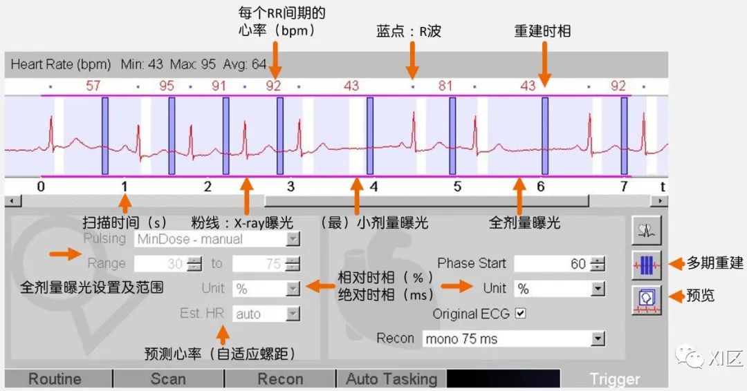 影像PPT - 冠脉CTA伪影与心电编辑策略-1 影像PPT - 冠脉CTA伪影与心电编辑策略-1