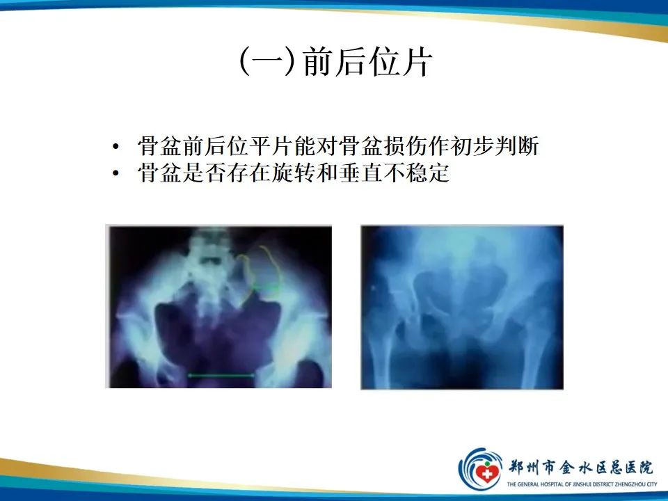 影像PPT - 【PPT】骨盆拍片技术与临床意义-5